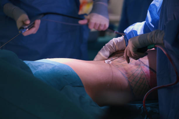 istock High definition liposuction in the operating room 1478006545