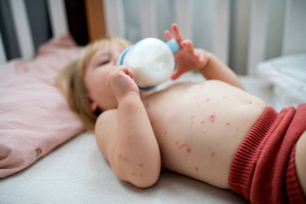 Cute ill baby girl with chickenpox lays in her crib and drinks milk stock photo