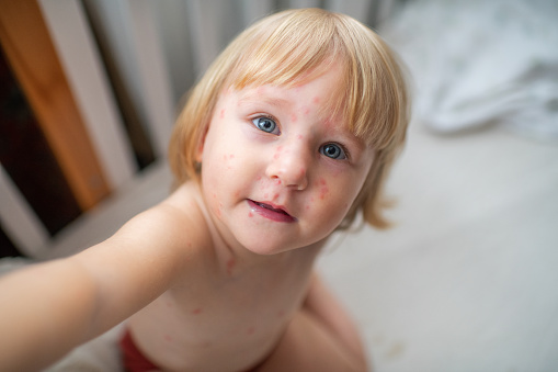 Child with chickenpox infectious disease