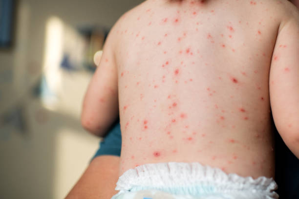Father holding his little daughter with chickenpox infection stock photo