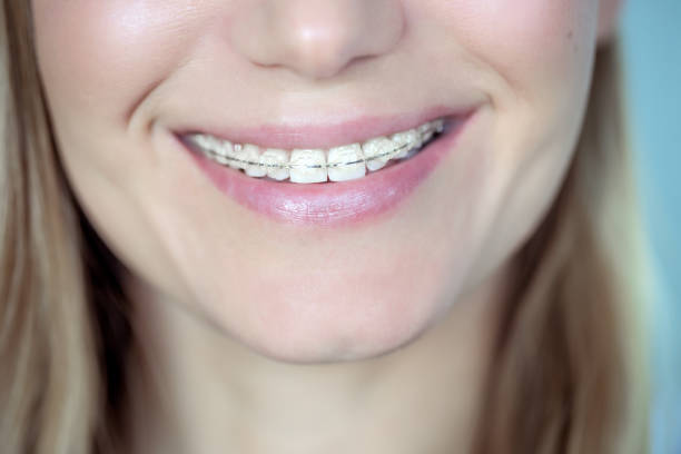 Adult woman with a braces stock photo