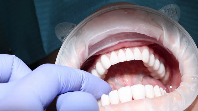 Installing white veneer on woman teeth in dentistry