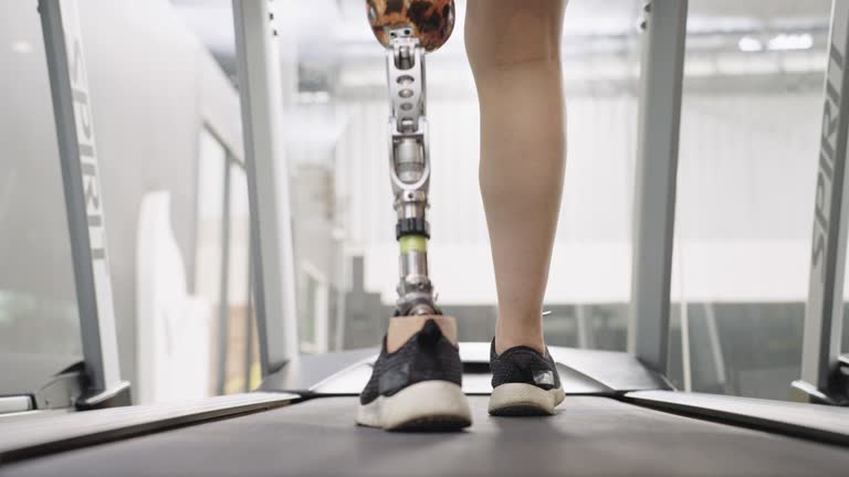 young woman with above knee leg prosthesis exercise on treadmill at gym.