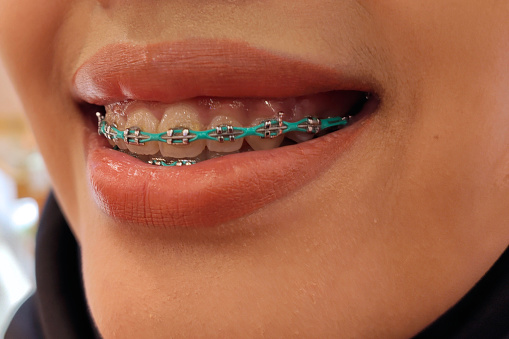 An Asian young woman is smiling showing dental braces.