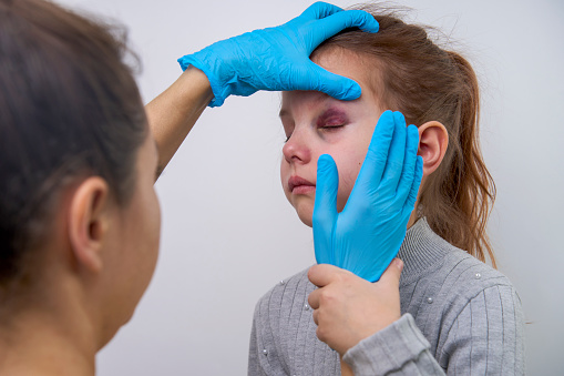 Doctor checking girl eye with bruise at hospital, closeup