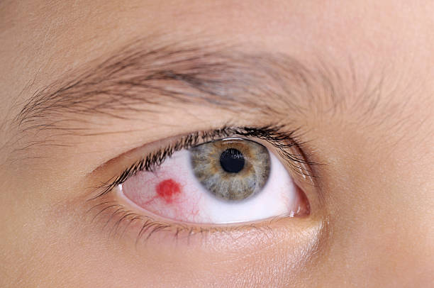 감염된 눈을 - conjunctivitis sore eyes child human eye 뉴스 사진 이미지