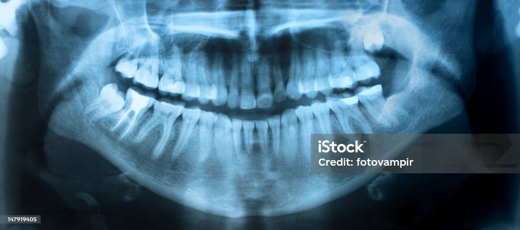 Dental X-Ray panoramic Dental X-Ray. A panoramic x-ray of a mouth, with intact wisdom teeth, one of which is severely impacted. X-ray Image Stock Photo