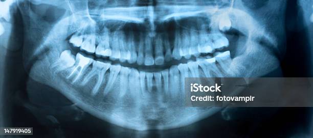 Dental Xray Panoramic Stock Photo - Download Image Now - X-ray Image, Wisdom, Dental Health