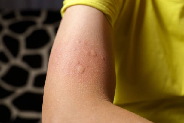 istock Allergy injection on the skin. Man hand close-up, selective focus 1479290743