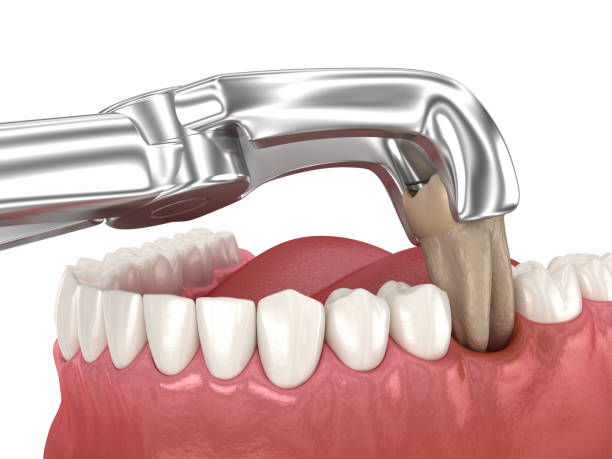 istock Extraction of Molar tooth damaged by caries. Dental 3D illustration 1479318921
