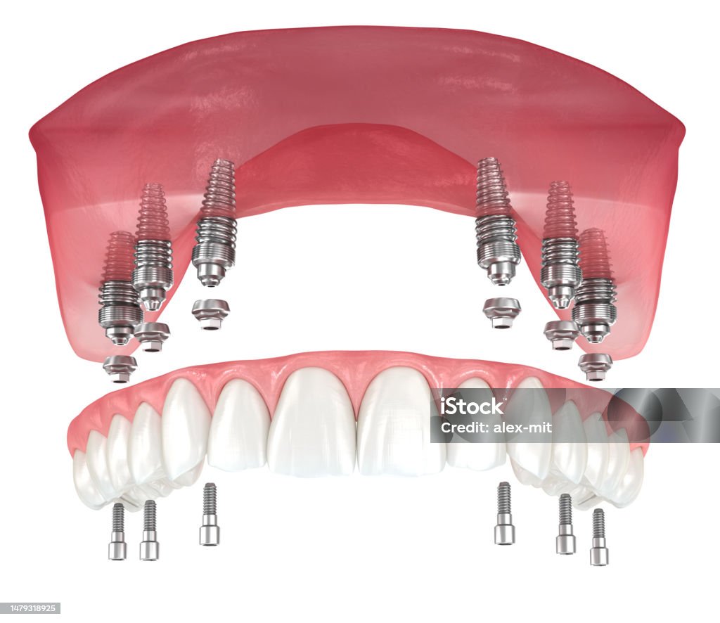 Maxillary Prosthesis Maxillary Prosthesis With Gum All On 6 System Supported By Implants ...