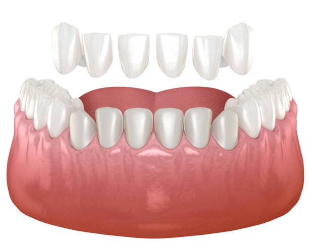 istock Dental veneer placement over frontal teeth. 3D illustration 1479318930
