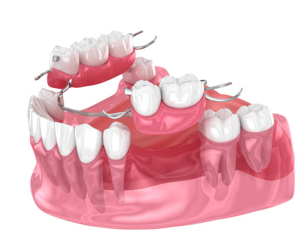 istock Removable partial denture, mandibular prosthesis. Medically accurate 3D illustration of prosthodontics concept 1479318939