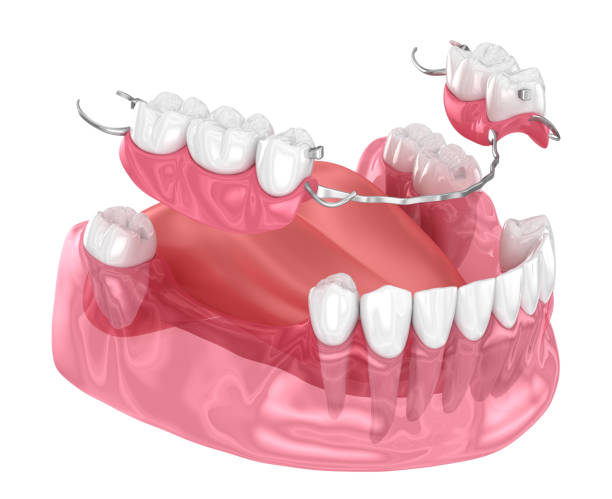 protesi parziale rimovibile, protesi mandibolare. illustrazione 3d medicalmente accurata del concetto di protesi - dentiera foto e immagini stock