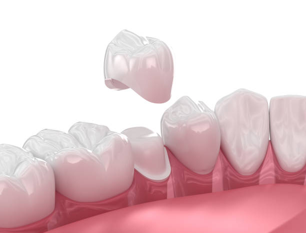 colocación de la corona dental sobre el diente. ilustración 3d - corona-dental fotografías e imágenes de stock