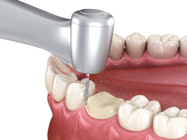 istock Premolar preparation process for dental crown placement. Dental 3D illustration 1479318989