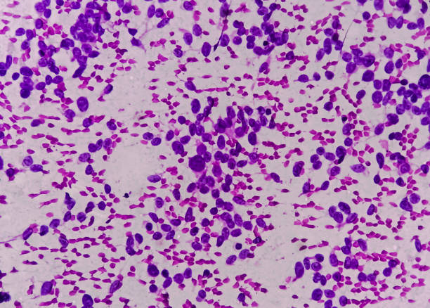 usg guided fna cytology of liver sol showing non hodgkin lymphoma. metastatic carcinoma. - non hodgkin lymphoma imagens e fotografias de stock