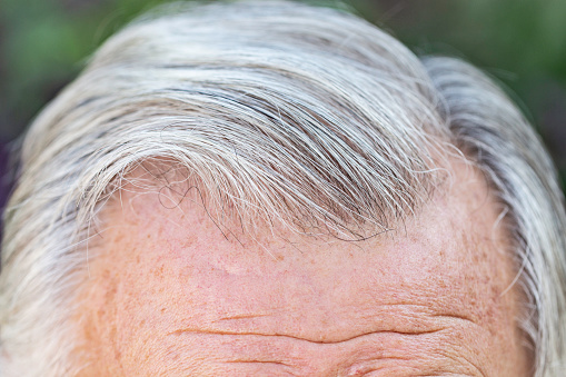 Hairline of a Senior Man. Representing hair loss problems of senior adults.