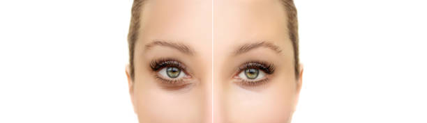 istock Lower and upper Blepharoplasty.Marking the face. plastic surgery concept. 1480129885
