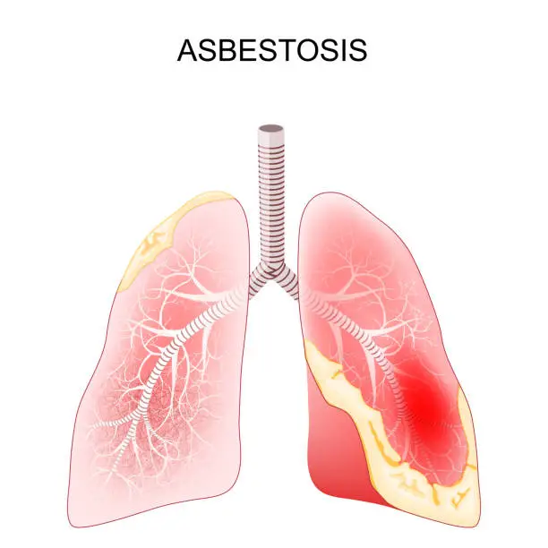 Vector illustration of Asbestosis. Close-up of a cross section of human lungs with fibrosis and scarring