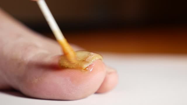 Apply the propolis solution on the nail affected by the fungus. Unconventional methods of nail fungus treatment.