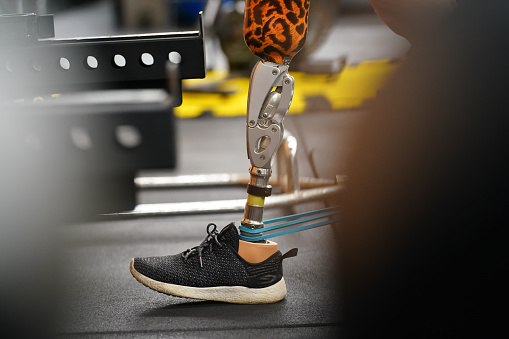 Young female with one prosthetic leg with exercise by walking on a treadmill to practice walking with the other prosthetic leg to be more flexible.