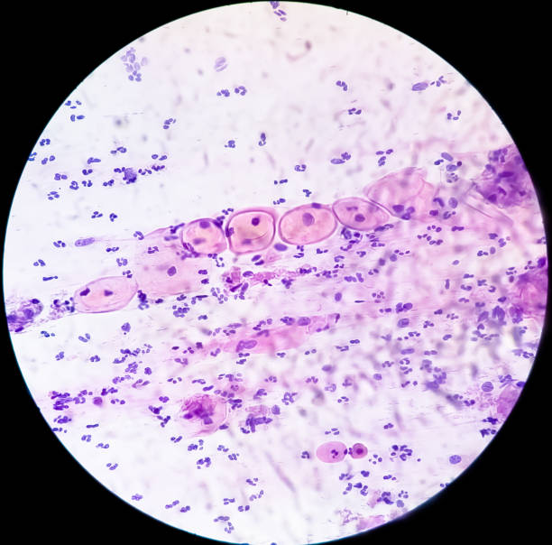 istock Photomicrograph of Paps smear: Inflammatory smear with HPV related changes. Cervical cancer. SCC 1480605342