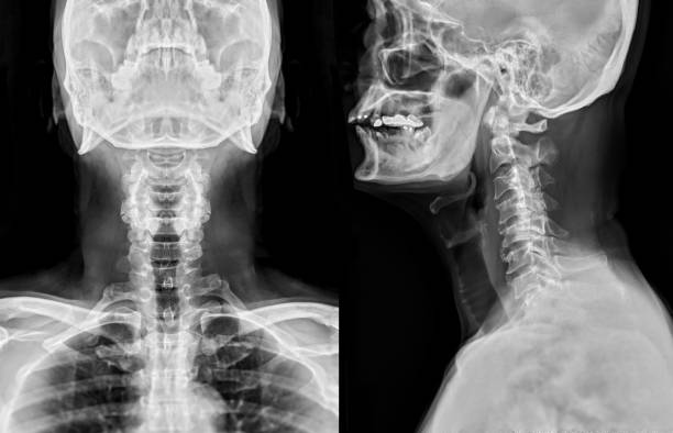 X-ray C-spine or x-ray image of Cervical spine AP and Lateral view for diagnostic intervertebral disc herniation ,Spondylosis and fracture. stock photo