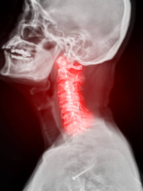 istock X-ray C-spine or x-ray image of Cervical spine lateral view for diagnostic intervertebral disc herniation ,Spondylosis and fracture. 1480757635