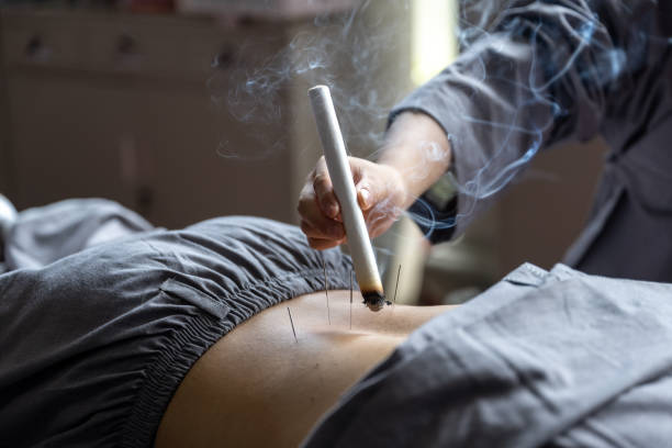 un uomo sta facendo agopuntura tcm e trattamento di moxibustione e moxibustione - traditional chinese medicine foto e immagini stock