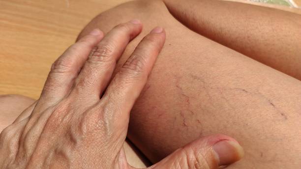 istock The varicose spider veins on the leg. 1480896521