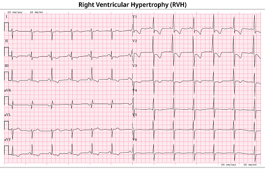ECG Right Ventricular Hypertrophy (LVH) - Left Ventricular Enlargement - 12 Lead ECG Common Case - 6 Sec/lead - Medical Vector Illustration