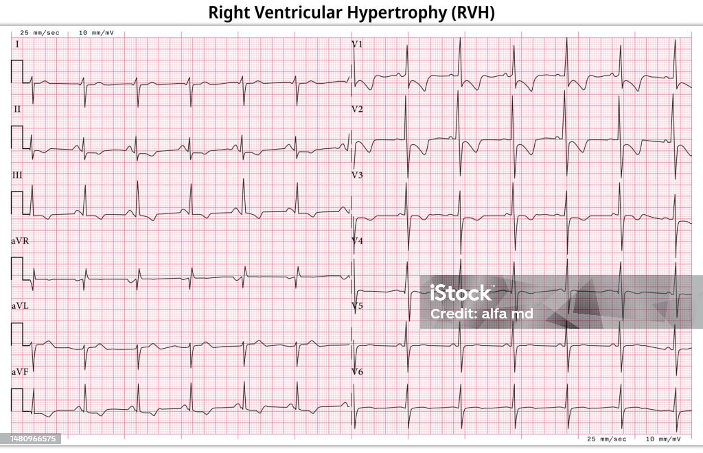 Ekg Rv Ecg Right Ventricular Hypertrophy Left Ventricular Enlargement 12 Lead ...