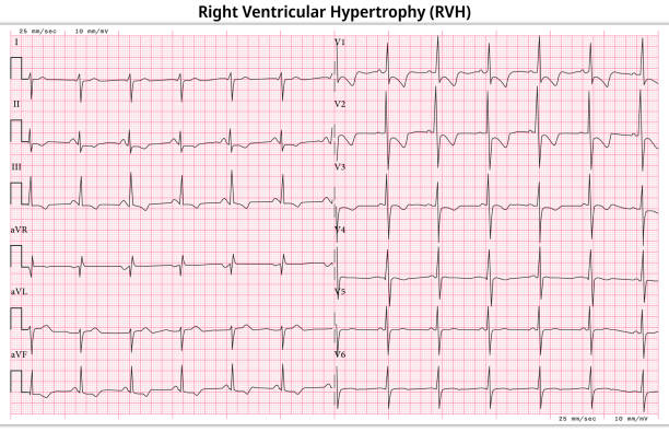 ECG Right Ventricular Hypertrophy (LVH) - Left Ventricular Enlargement - 12 Lead ECG Common Case - 6 Sec/lead ECG Right Ventricular Hypertrophy (LVH) - Left Ventricular Enlargement - 12 Lead ECG Common Case - 6 Sec/lead - Medical Vector Illustration heart ventricle stock illustrations