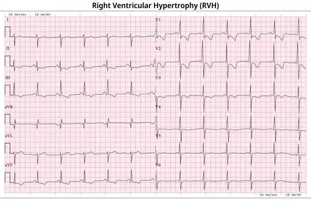 Vector illustration of ECG Right Ventricular Hypertrophy (LVH) - Left Ventricular Enlargement - 12 Lead ECG Common Case - 6 Sec/lead