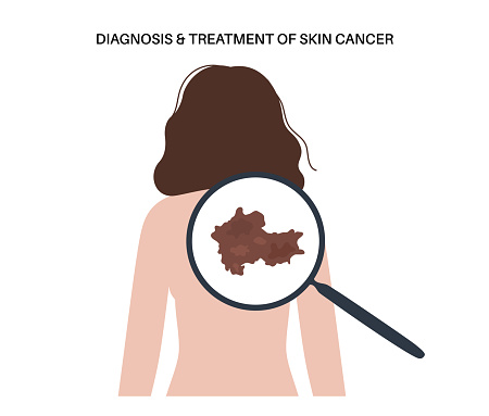 Melanoma on the back of a woman, skin cancer development. Malignant tumor diagnostic and treatment. Pigment producing melanocytes cells. Dermatology examination in laboratory flat vector illustration