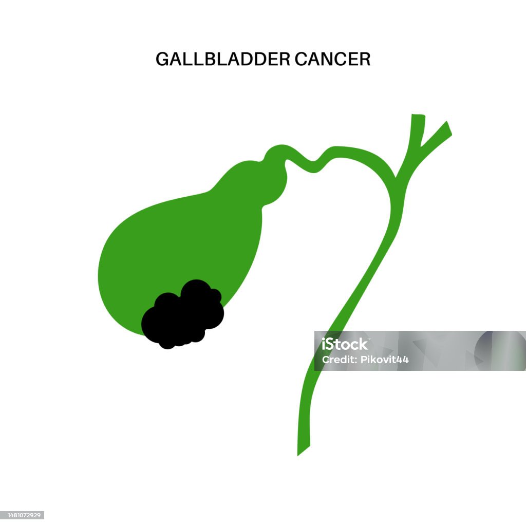 Cancer In Gallbladder Gallbladder Cancer Anatomy Stock Illustration - Download Image Now ...