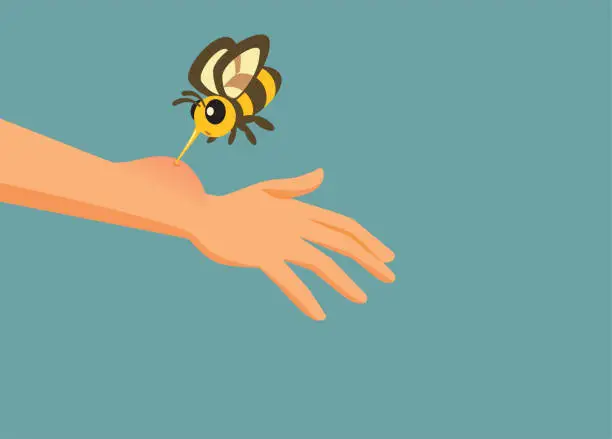 Vector illustration of Hand Stung by a Bee Having an Allergic Reaction Vector Illustration