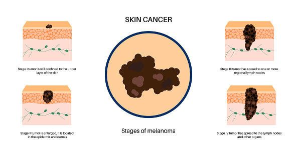 Stages of melanoma skin cancer development and progression. Malignant tumor growth into the skin layers from epidermis to other internal organs. Diagnostic and treatment in dermatology clinic vector