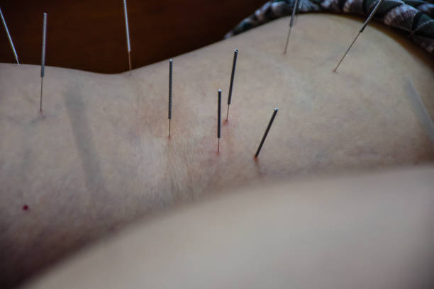 istock Traditional Chinese Medicine Acupuncture on back knee. 1481281849