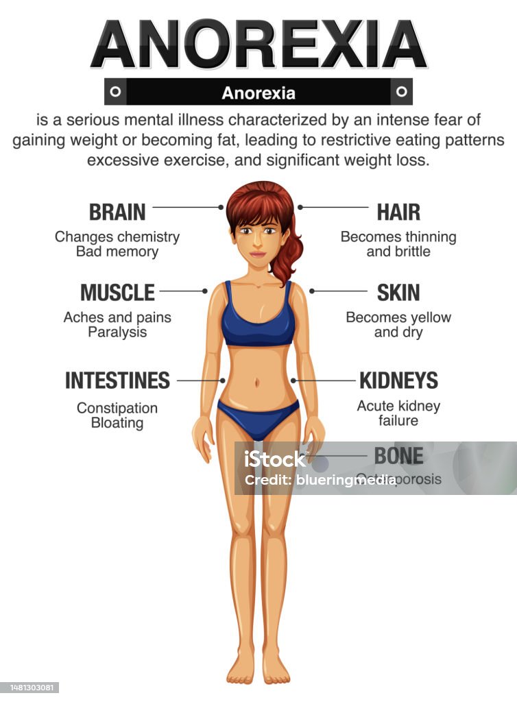 Vetores De Anorexia E Seus Efeitos Sobre O Corpo E Mais Imagens De vetores-de-anorexia-e-seus-efeitos-sobre-o-corpo-e-mais-imagens-de