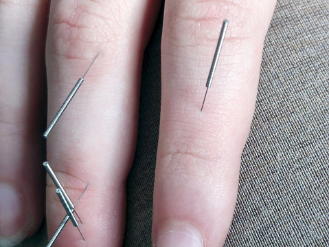 Su Jok therapy, Su Jok needles on female fingers close-up