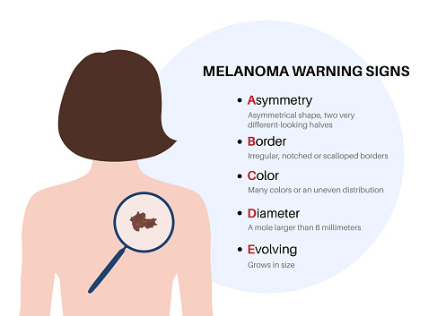 Melanoma warning signs. ABCDE rule for skin cancer. Asymmetrical shape, irregular border, many colors, big diameter, evolving size of mole. Oncology prevention medical poster flat vector illustration.
