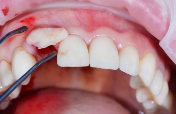 procédures d’augmentation des tissus mous. greffe de gencive du palais dans la zone de la dent retirée avec la pose de l’implant. pour compenser l’insuffisance des tissus mous - dentist office dentists chair dentist dental hygiene photos et images de collection