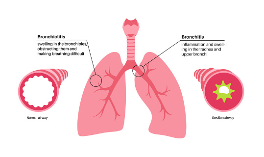 Bronchitis Und Bronchiolitis Stock Vektor Art und mehr Bilder von
