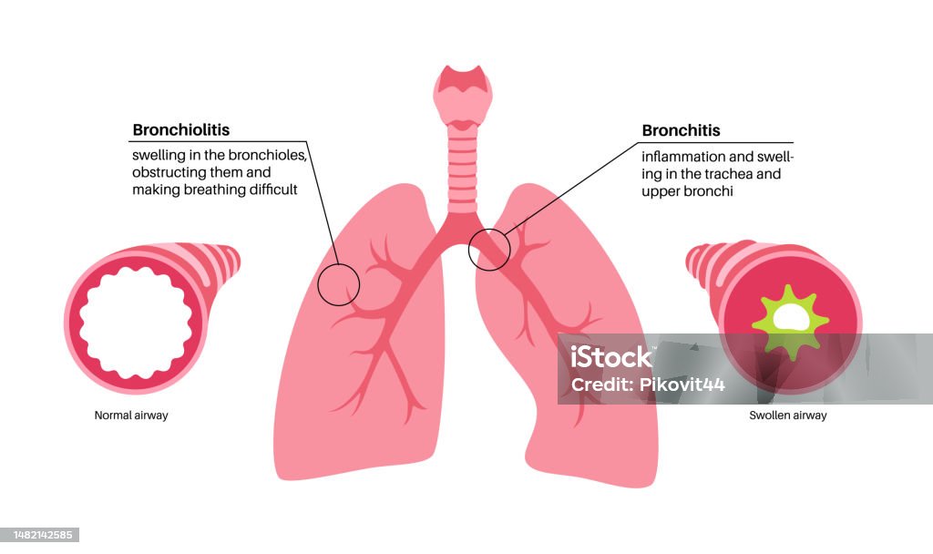 Bronchitis Visual Bronchitis And Bronchiolitis Stock Illustration - Download Image Now ...