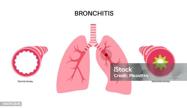 Bronke Bronchitis Lung Disease Stock Illustration - Download Image Now ...