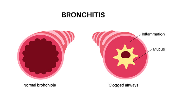 Bronke Bronchitis Lung Disease Stock Illustration - Download Image Now ...