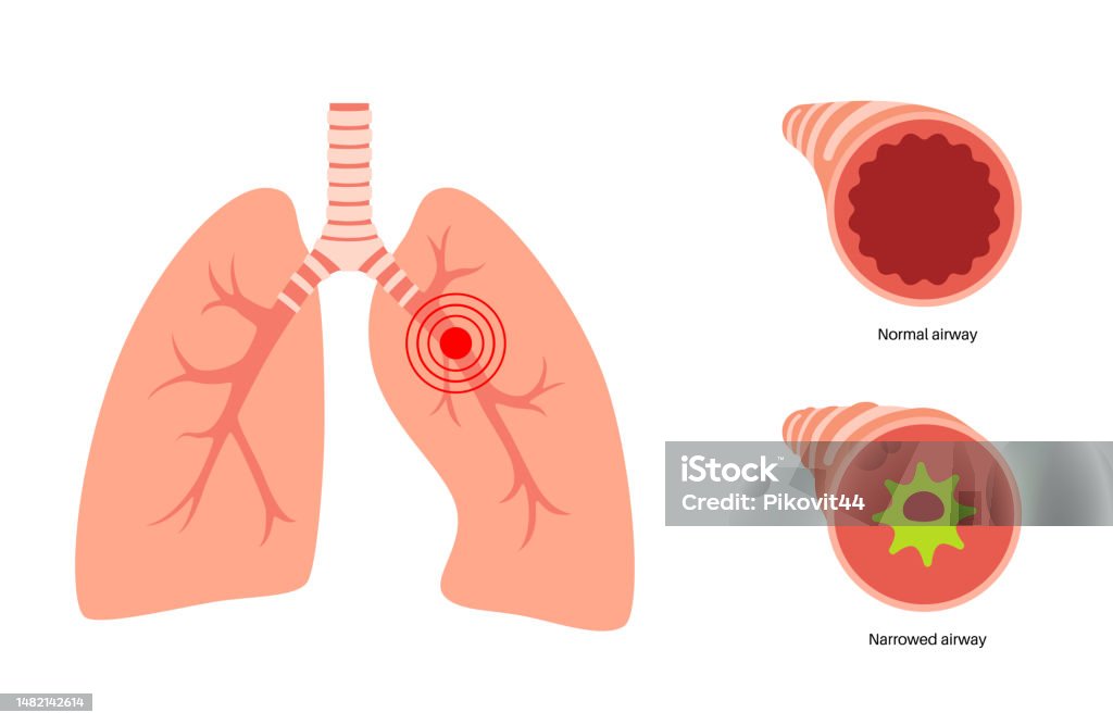 Bronke Bronchitis Lung Disease Stock Illustration - Download Image Now - Baby ...