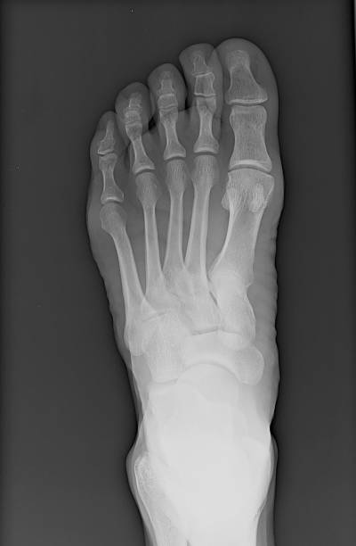 Left Foot X-Ray stock photo